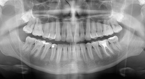 radiografia panoramica dental