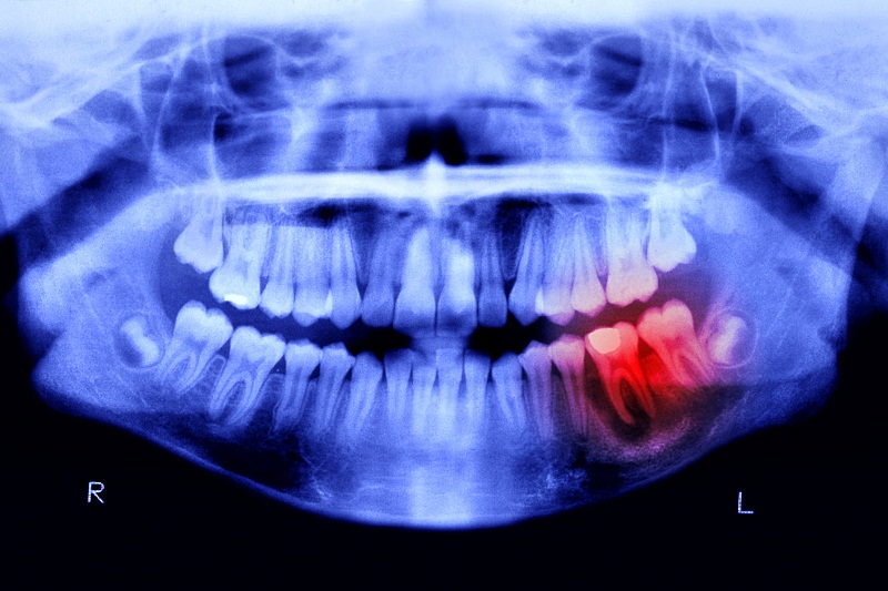 Czy potrzebny jest rentgen zębów ?